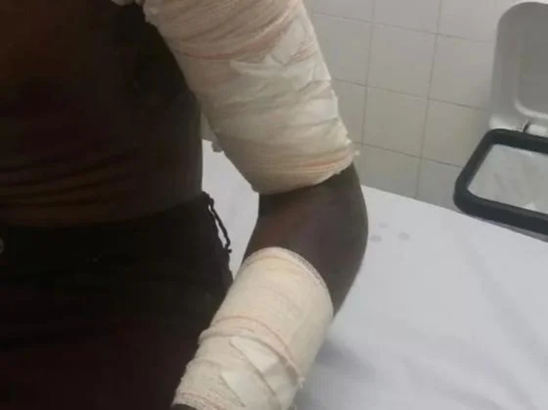 Discussão entre casal termina com queimaduras graves e facada em Ji-Paraná